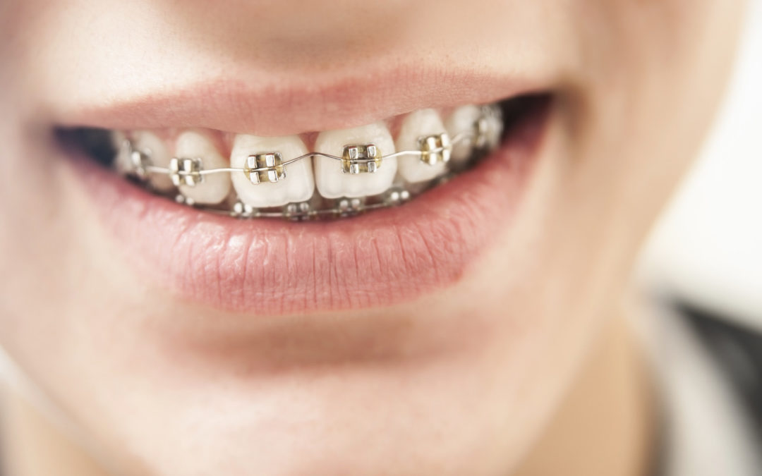 Metal vs Ceramic Braces: Which Smile Solution is Right for You?