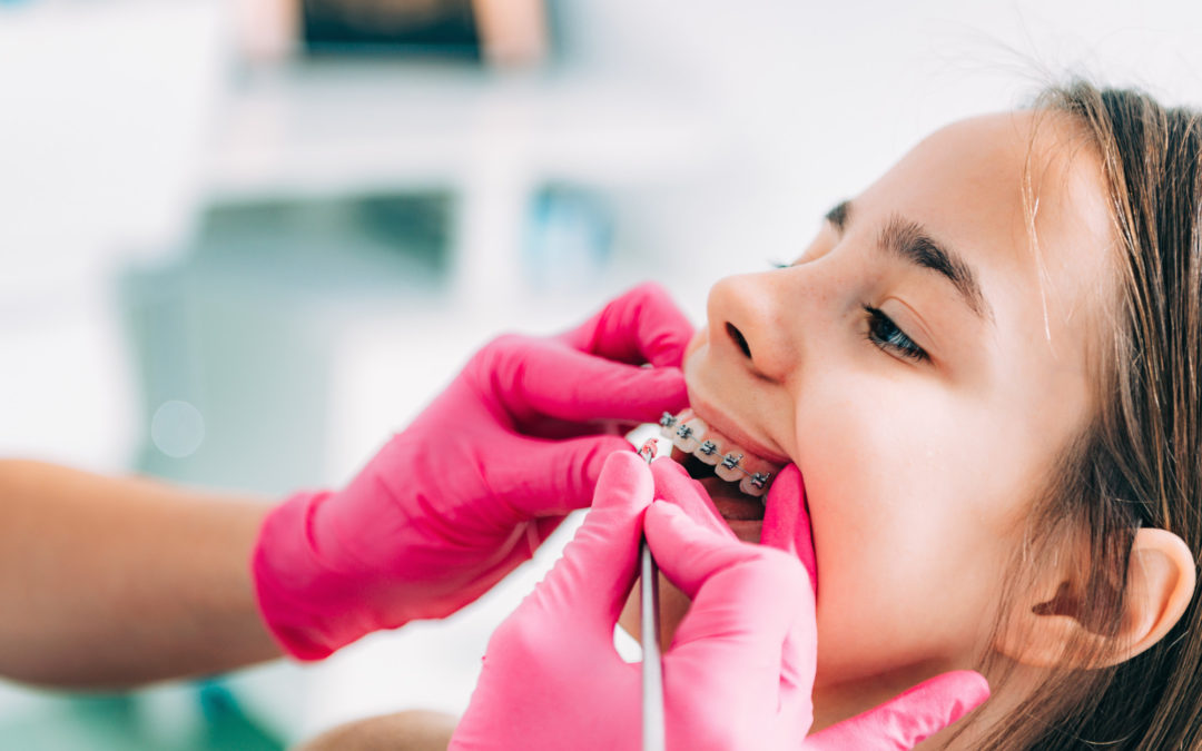How to Choose Braces for Kids: Everything You Need to Know
