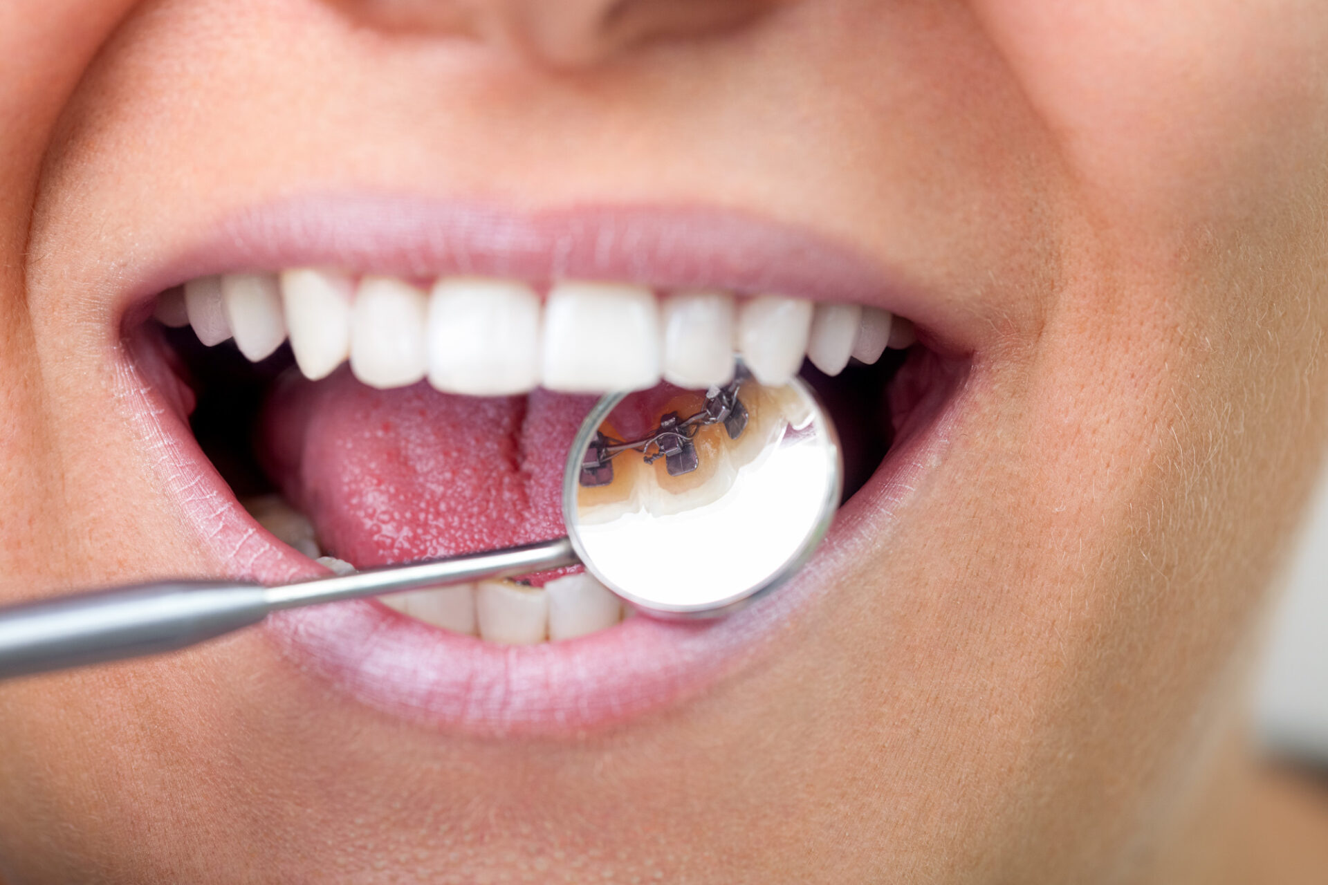 alternatives to braces