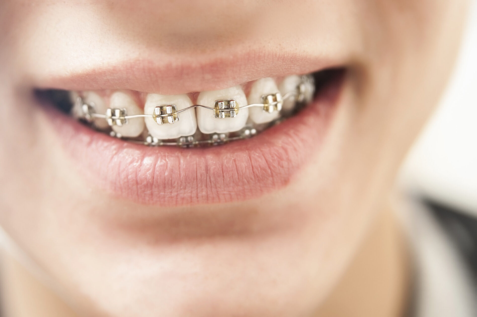 metal vs ceramic braces