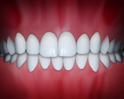 Dental Midlines not Matched diagram