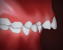 Upper Front Teeth Protrusion diagram