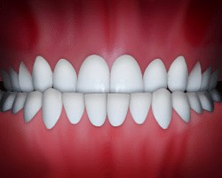 Underbite diagram